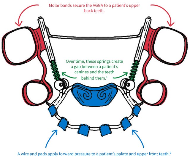 Illustration of AGGA dental device