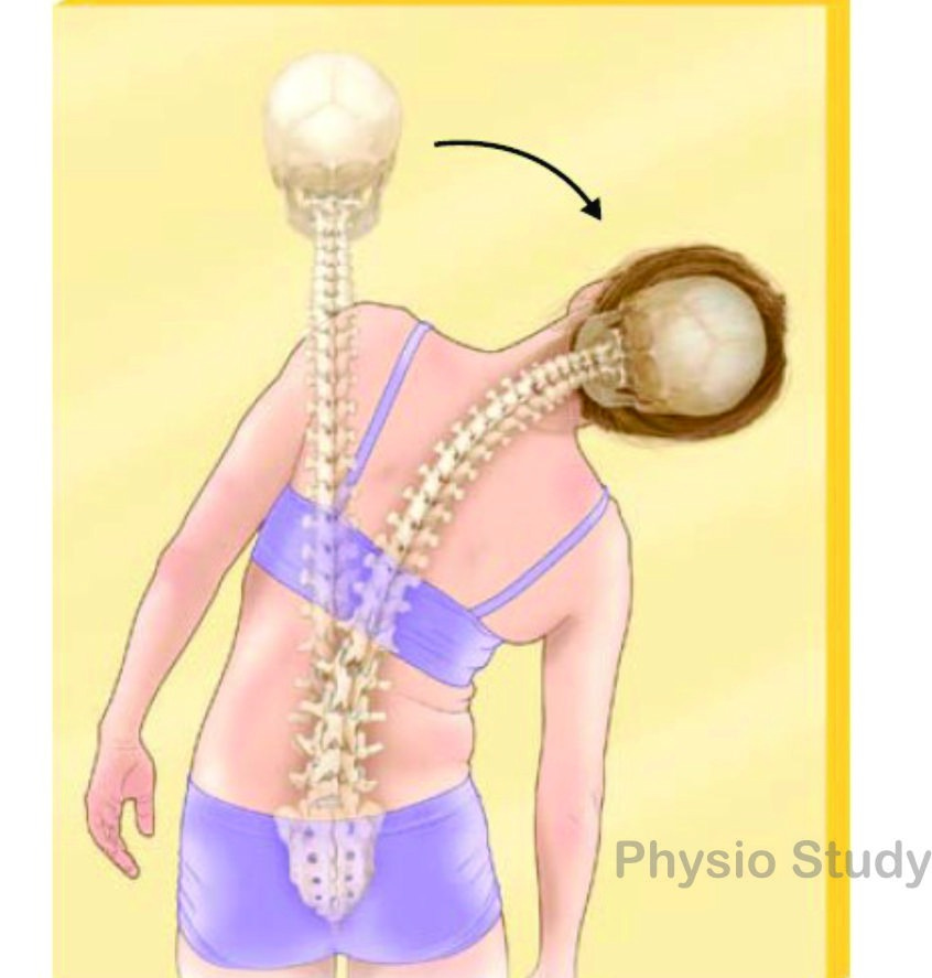 Physio Study on X: "Lateral flexion: A side-bending movement of the spine either to the right or to the left. #flexion #lateralflexion #spine #movement https://t.co/NGJli1TSBJ" / X Physio Study on X: "Lateral flexion: A side-bending movement of the spine either to the right or to the left. #flexion #lateralflexion #spine #movement https://t.co/NGJli1TSBJ" / X