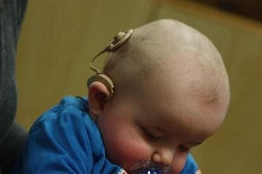 Image result for cochlear implant