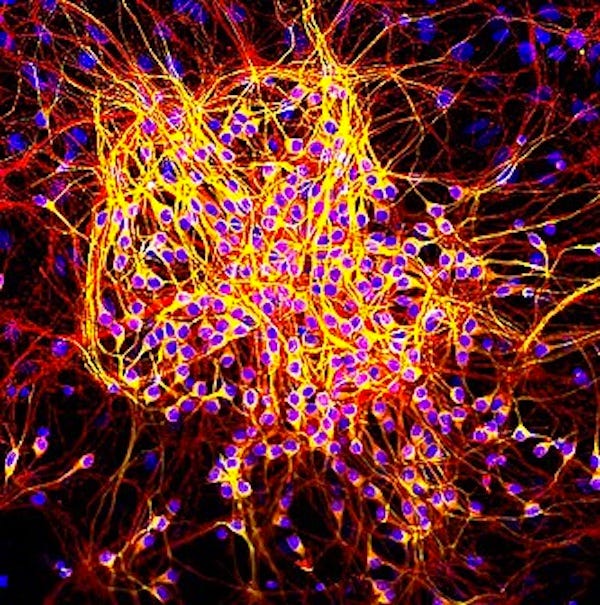A photograph of neurons entagled with tau proteins, from the wikipedia page about tau.