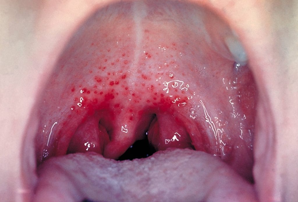 Strep throat - Symptoms & causes - Mayo Clinic