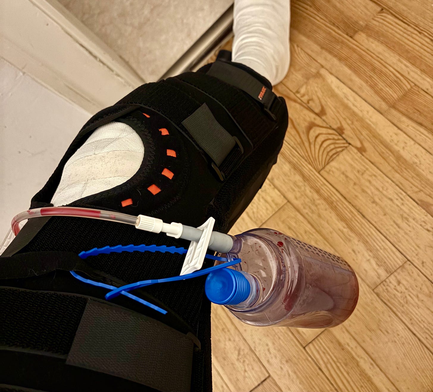 A leg in a bandage with a leg brace and a drainage bottle