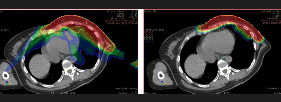 imrt proton chestwall comparison plans Mark Storey MD