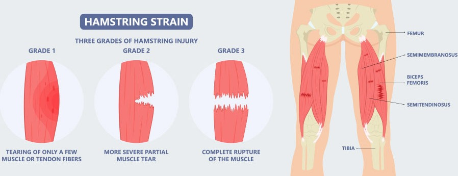 Hamstring Injury: Causes, Symptoms And Treatment