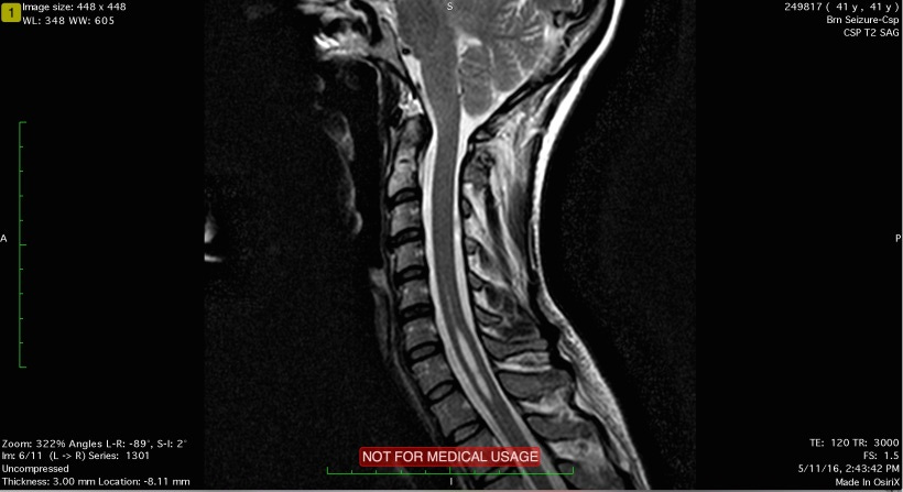 MRI image showing a silvery cavity in my cervical spinal cord.