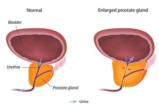 Diagram showing a normal and an enlarged prostate below the bladder and surrounding the urethra. The enlarged prostate is bigger and the urethra is narrower.