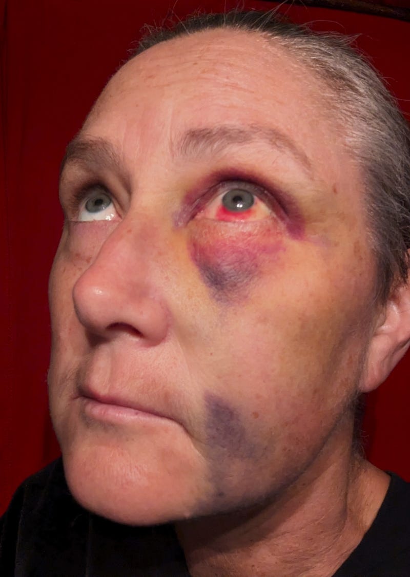 Bruises after Matear assault