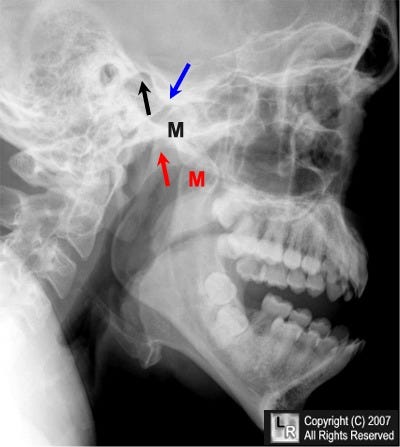 Learning Radiology - Dislocated, Mandible, Mandibular, Dislocation