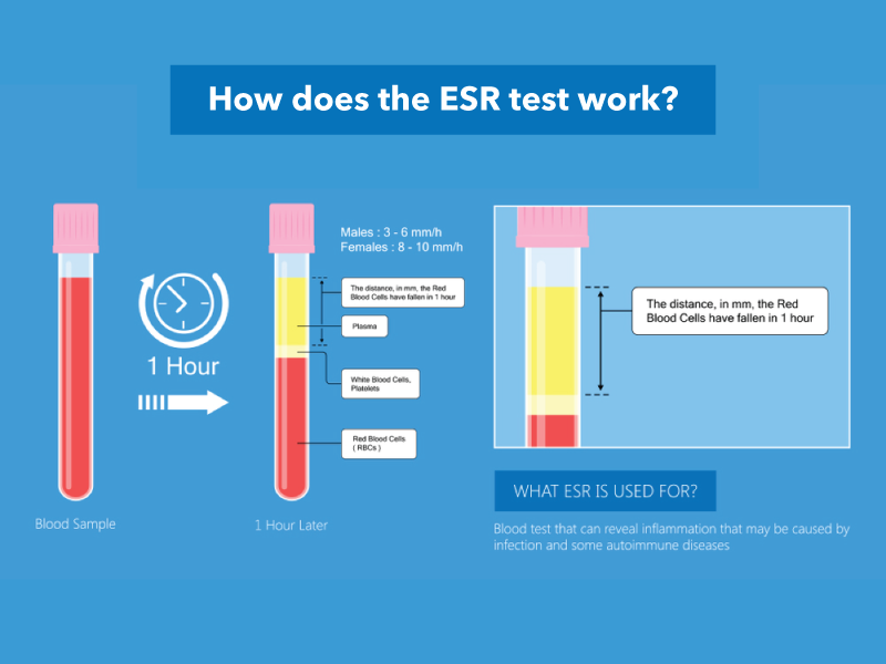 Decoding ESR Test: What Your Results Could Reveal About Your Health |  Pathkind Labs Blog