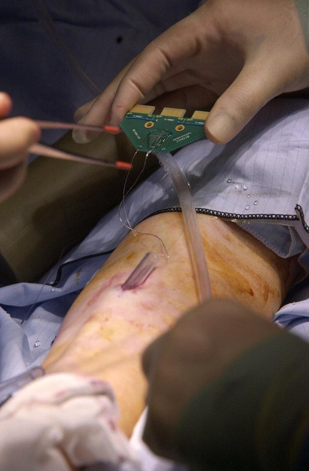 Surgeons operating on Professor Kevin Warwick to place a microchip into his arm in March 2002