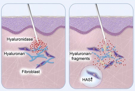 Hialuronidase, preenchimento facial, harmonização orofacial