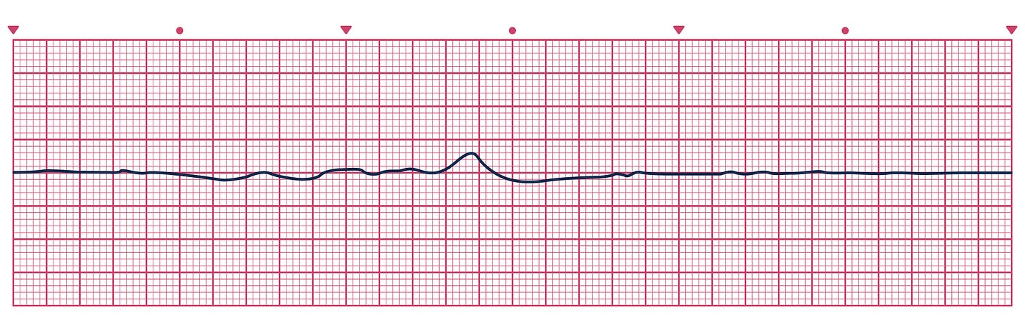 An ECG depicting Asystole