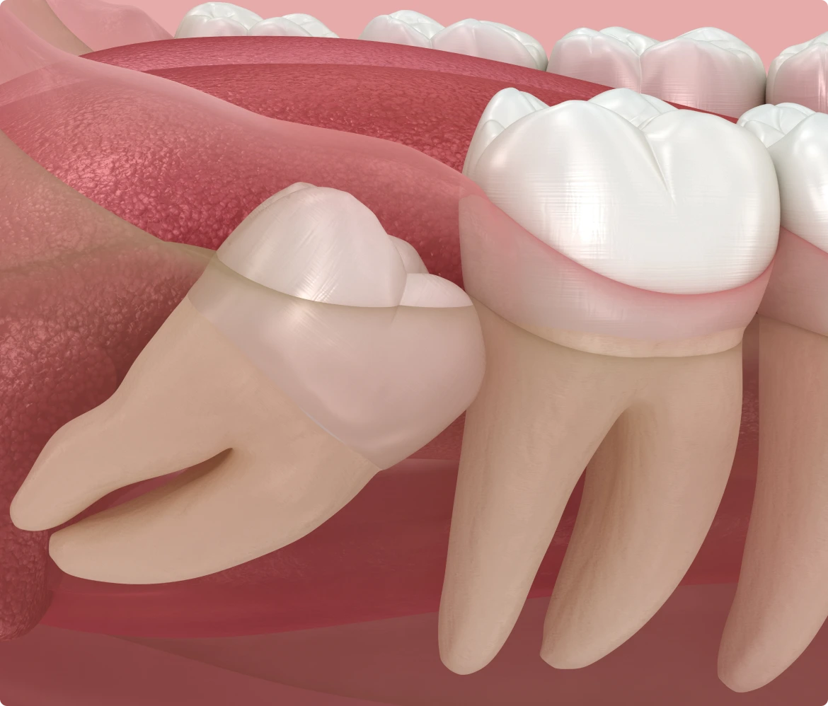 Best Wisdom Teeth Removal in Denver, CO | Pain-Free Extraction