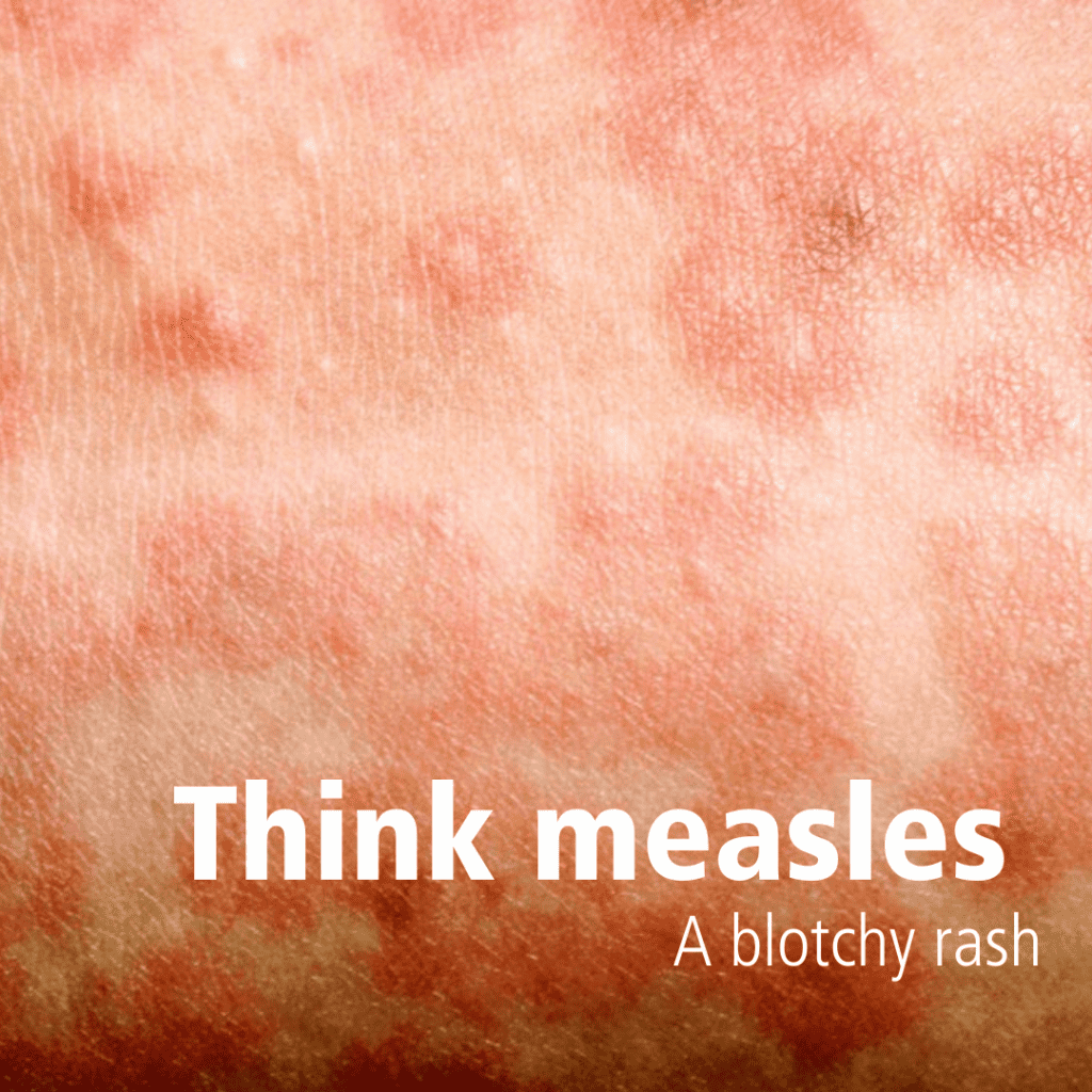 Think measles! - Birmingham and Solihull Mental Health NHS Foundation Trust