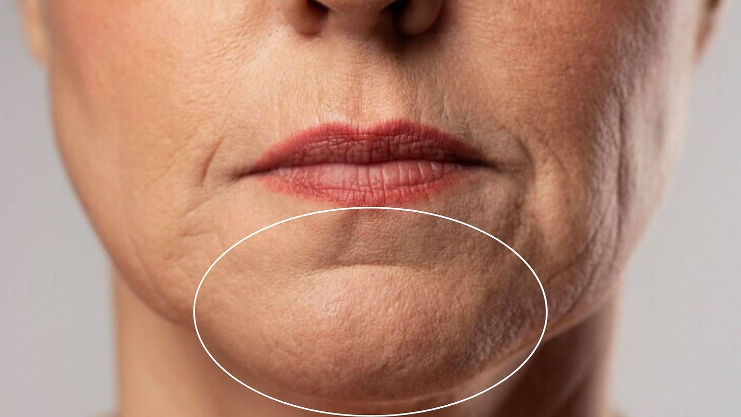 Chin Wrinkles | Beauty Enhancement Services Swindon