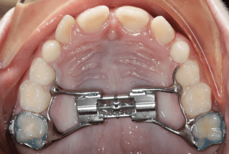 What is an expander ? | Read all you need to know here.