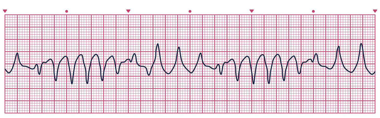 An ECG depicting Torsades de Pointes