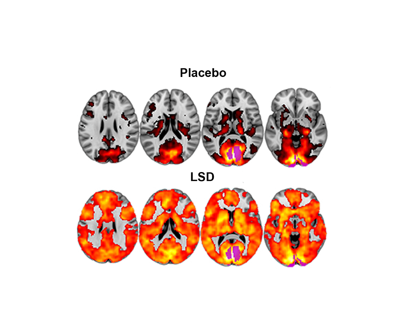 The Brain on LSD Revealed: First Scans Show How the Drug Affects the Brain  |The Beckley Foundation