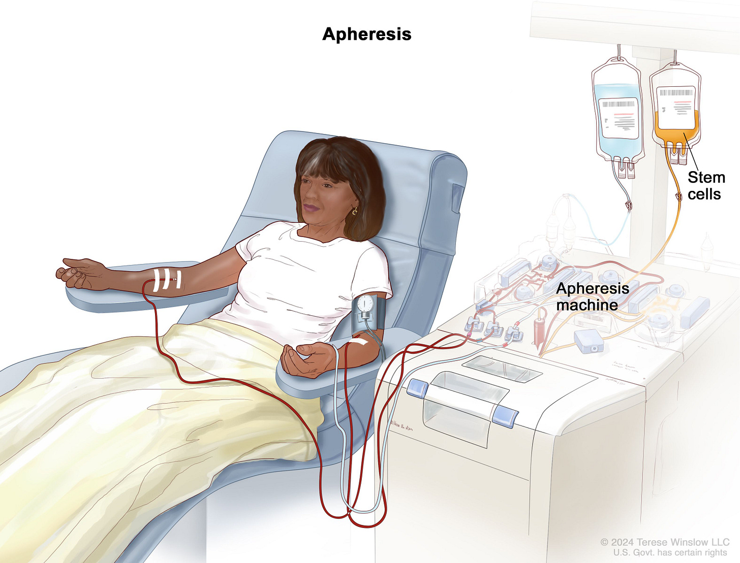 Definition of apheresis - NCI Dictionary of Cancer Terms - NCI