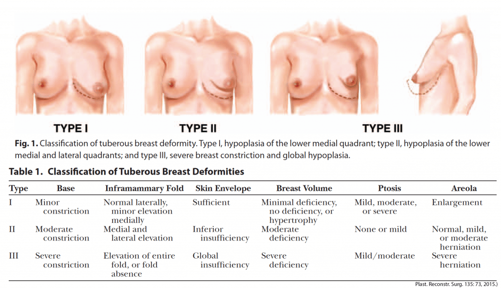 Tuberous Breast Deformity: Classification And Treatment