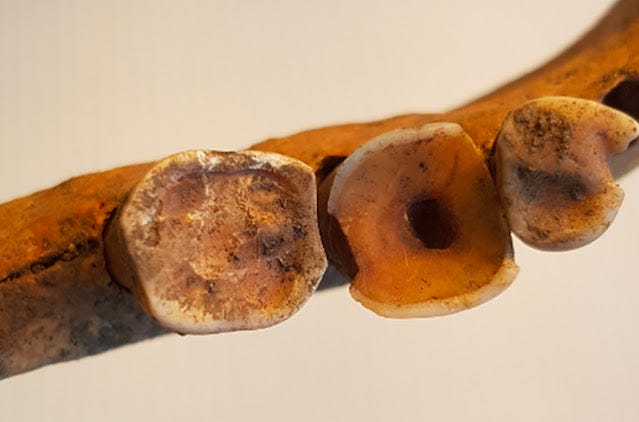 Evidência de obturação em um dente Viking. (Carolina Bertilsson) Evidência de obturação em um dente Viking. (Carolina Bertilsson)