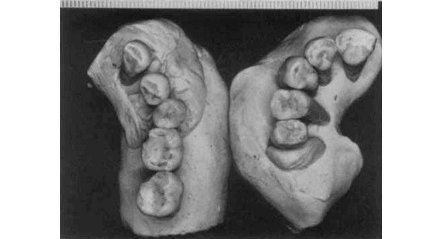 Part of an lower and upper set of teeth refitted with plasticine into occlusal shape Part of an lower and upper set of teeth refitted with plasticine into occlusal shape