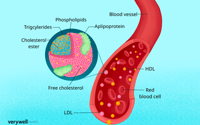 Reducing Your Small, Dense LDL Cholesterol