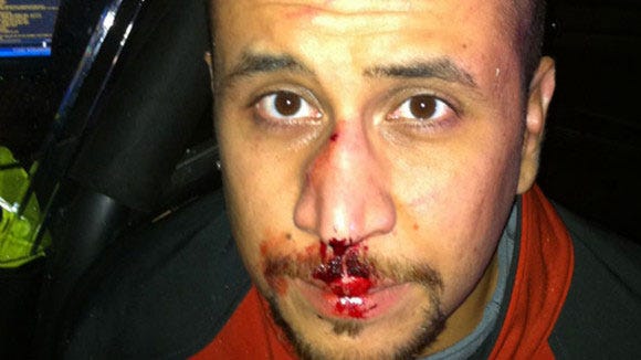 George Zimmerman with a broken nose