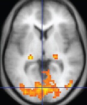 fMRI scan showing activity in a slice of the brain