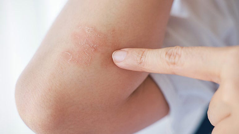 vitamin d and spice for psoriasis