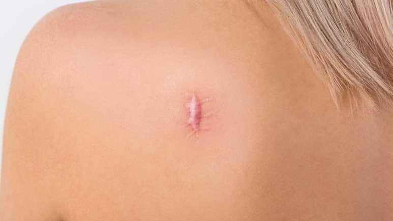vitamin d wounds and keloids