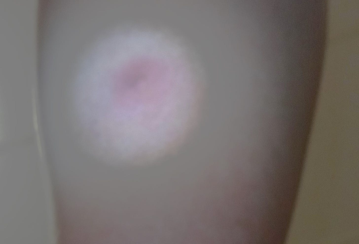 A one inch diameter sore with an insect bite at the center. Photo property of author.