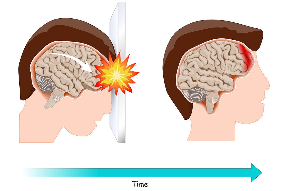 Traumatic Brain Injury with No Symptoms - Ogborn Mihm, LLP