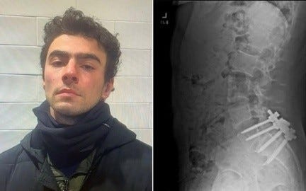 Luigi Mangione sufria espondilolistesis, según radiografías publicadas en sus redes sociales.