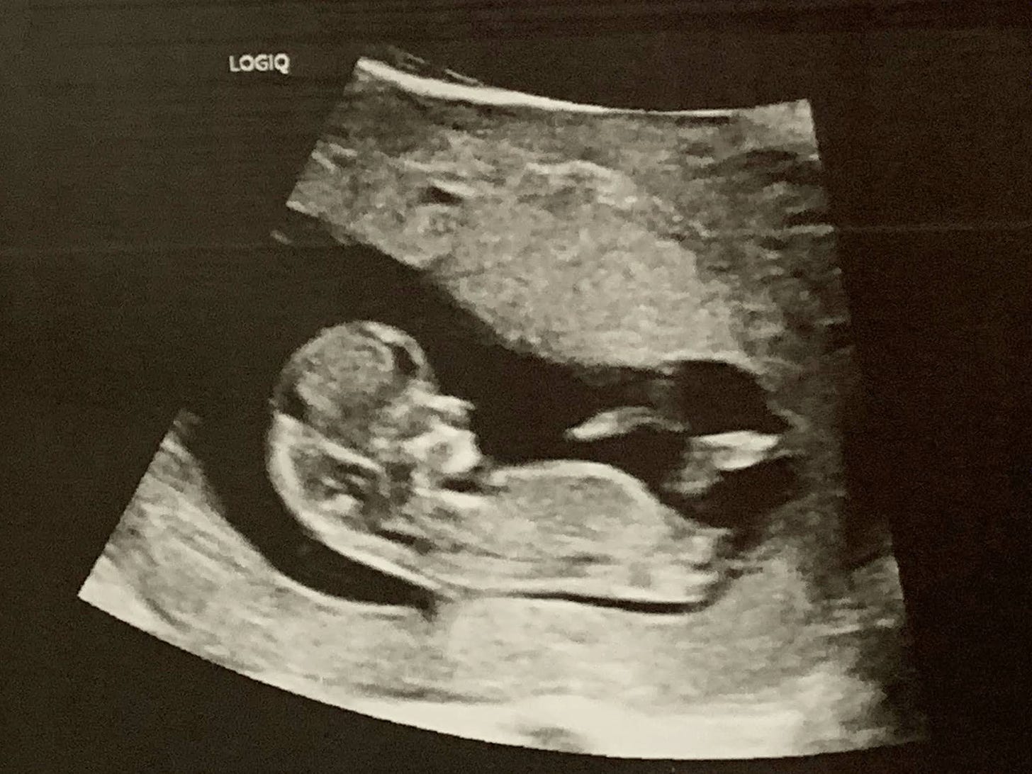 Ultrasound image of a baby in the womb