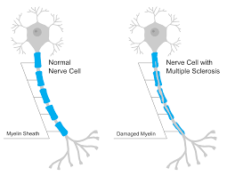 File:Myelin sheath damage in multiple ...