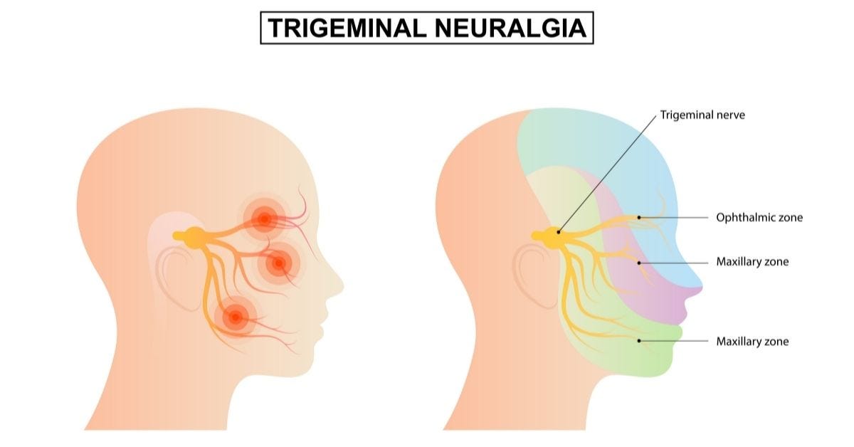 How to cope with trigeminal neuralgia pain? | Sri Ramakrishna Hospital