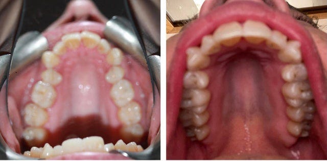I can't believe how much Invisalign has expanded my dental arch. :  r/Invisalign
