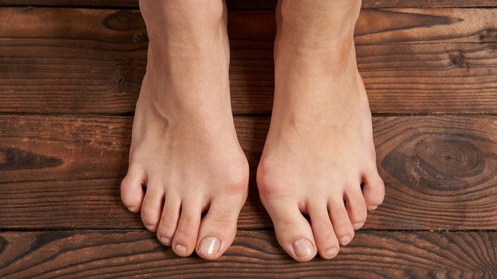 What Is a Bunion? Hallux Valgus Causes and Treatments - GoodRx