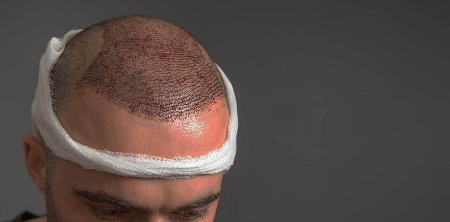 Hair Transplant Post Operative Guide | Care4Hair