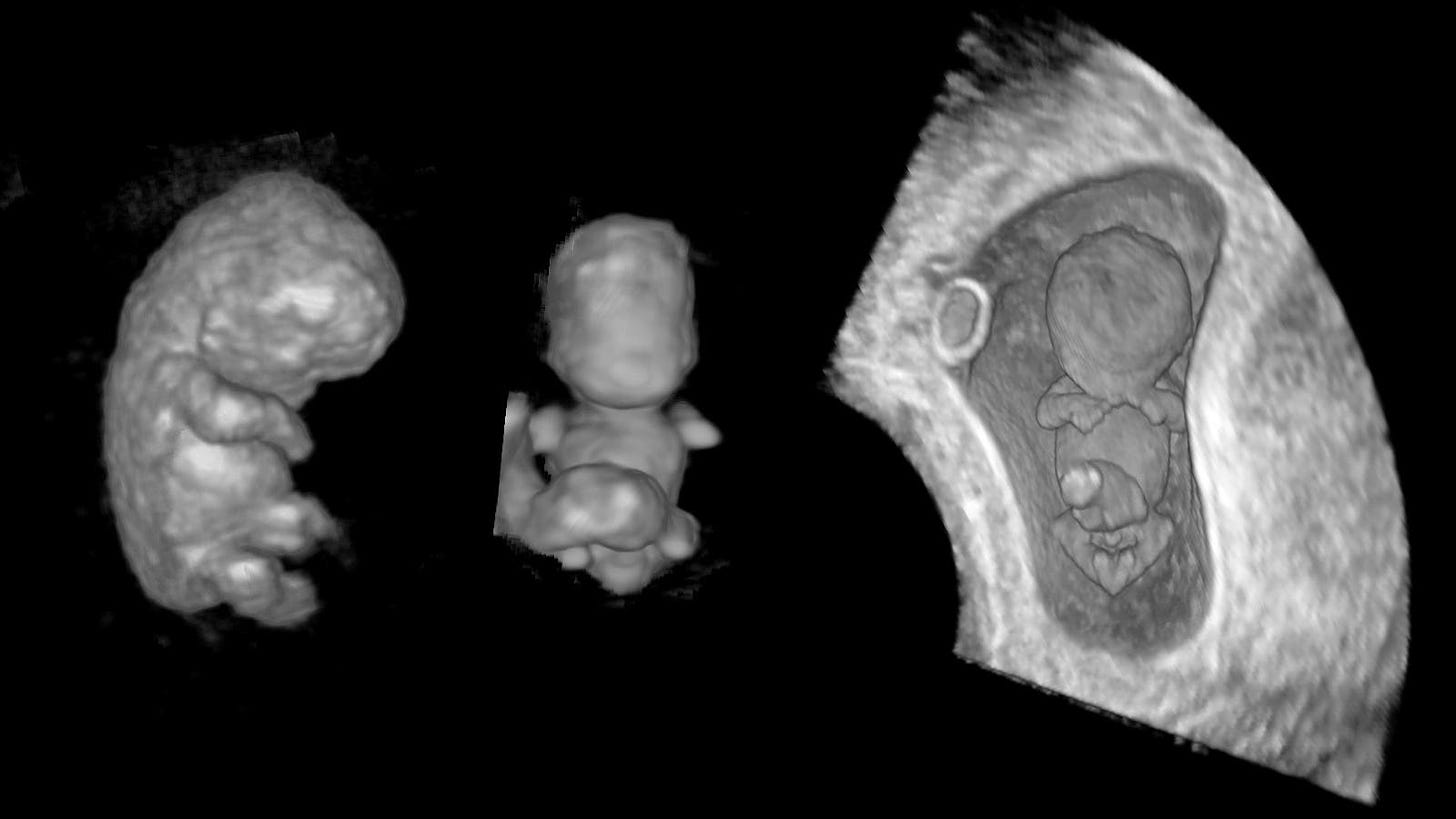 3D ultrasounds of an embryo at 8, 9.5 and 10 weeks of gestation.