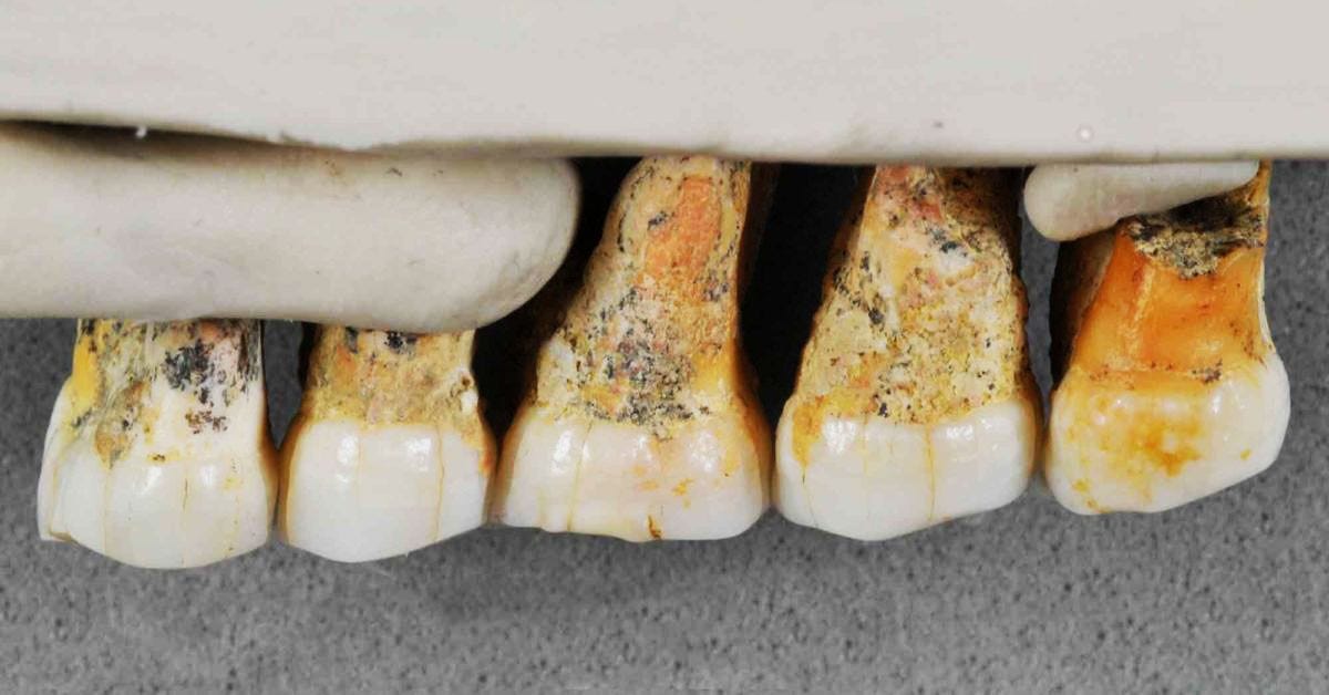 Teeth from the Homo luzonensis individual from Callao Cave