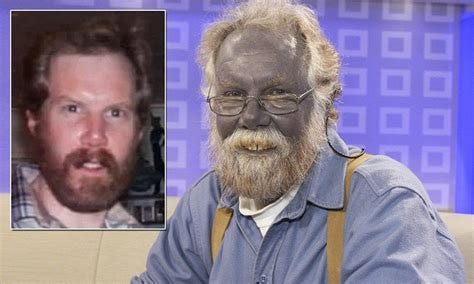 Argyria a rara doença da pele azul | Mundo do Curioso