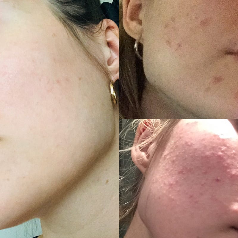 An image showing my skin before and after veganism