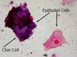 Clue Cells( Vaginosis)... - Medical Laboratory Technology | Facebook