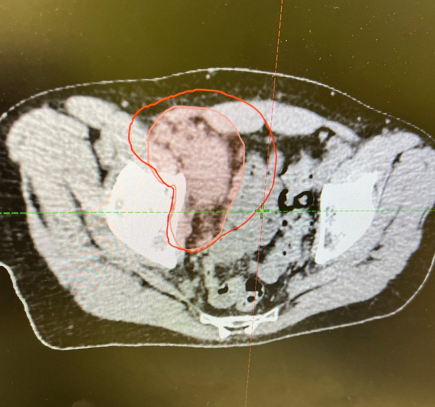 image: pet scan image showing tumour 