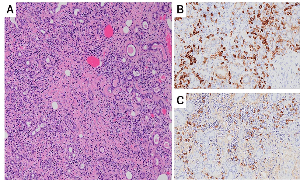 Light-microscopy-of-the-submandibular-gland-biopsy.