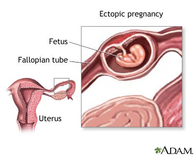 Ectopic pregnancy: MedlinePlus Medical Encyclopedia Image
