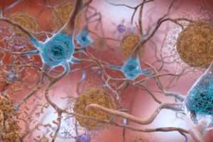 In the Alzheimer’s affected brain, abnormal levels of the amyloid-beta protein clump together to form plaques (brown) that collect between neurons and disrupt cell function. Abnormal collections of the tau protein accumulate and tangle (blue) within neurons, harming synaptic communication between nerve cells. Image courtesy of National Institute on Aging, NIH.