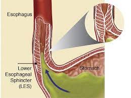 Acid Reflux | Low Country Reflux Center